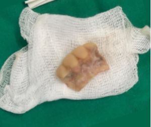 Extraen prótesis dentaria de la laringe de un hombre