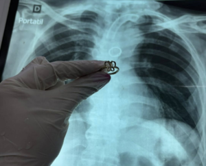 Ineram: el insólito hallazgo dentro del pulmón de un hombre de 54 años