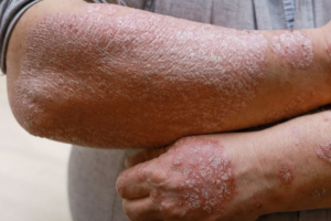 Psoriasis: organizan jornada gratuita para pacientes y familias